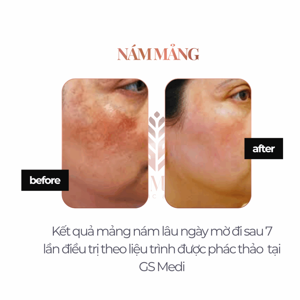 liệu trình điều trị nám Laser O2 tại GS Medi