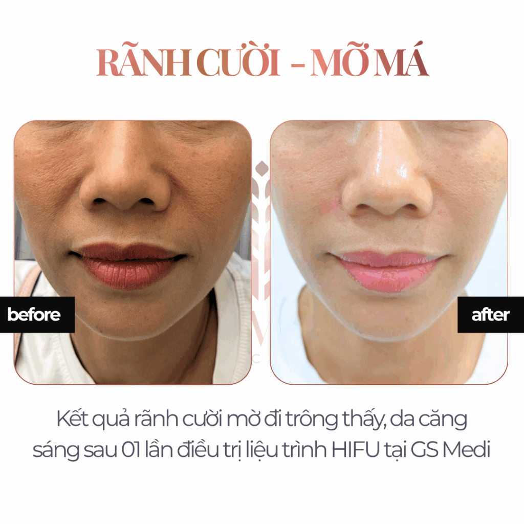 Điều trị Rãnh cười