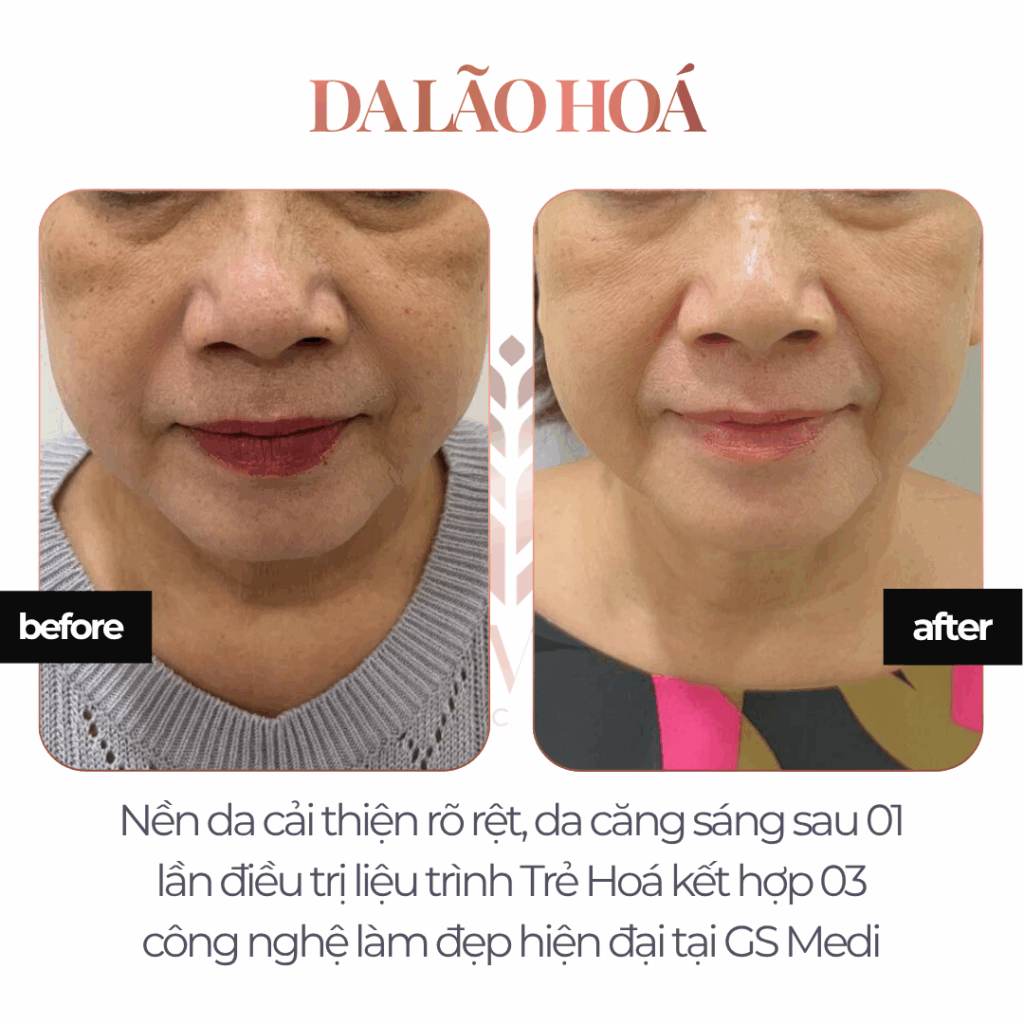 Điều trị Da Lão Hoá