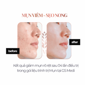 kết quả điêù trị mụn viêm, sẹo nong tại GS Medi 