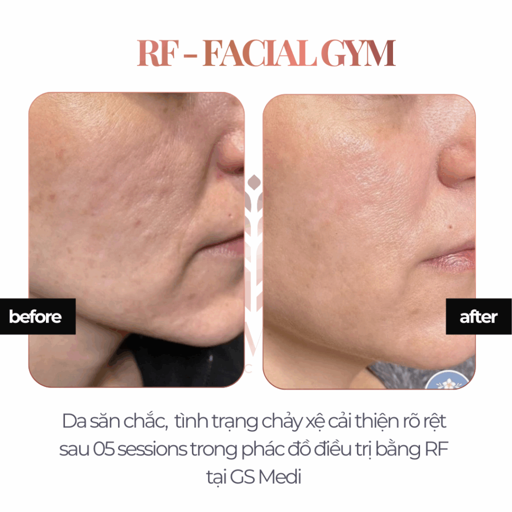RF - Facial Gym
