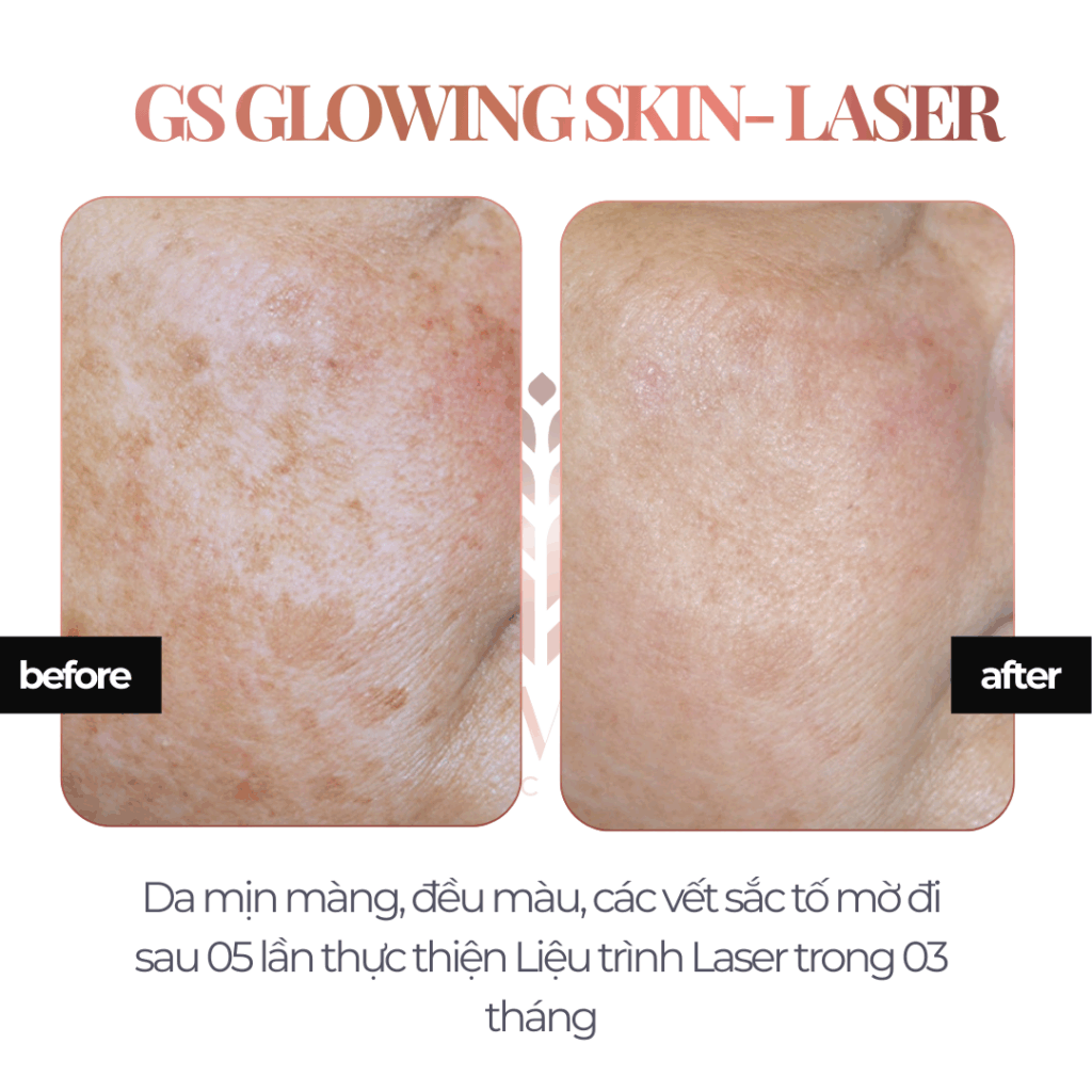 Liệu trình sáng da Laser