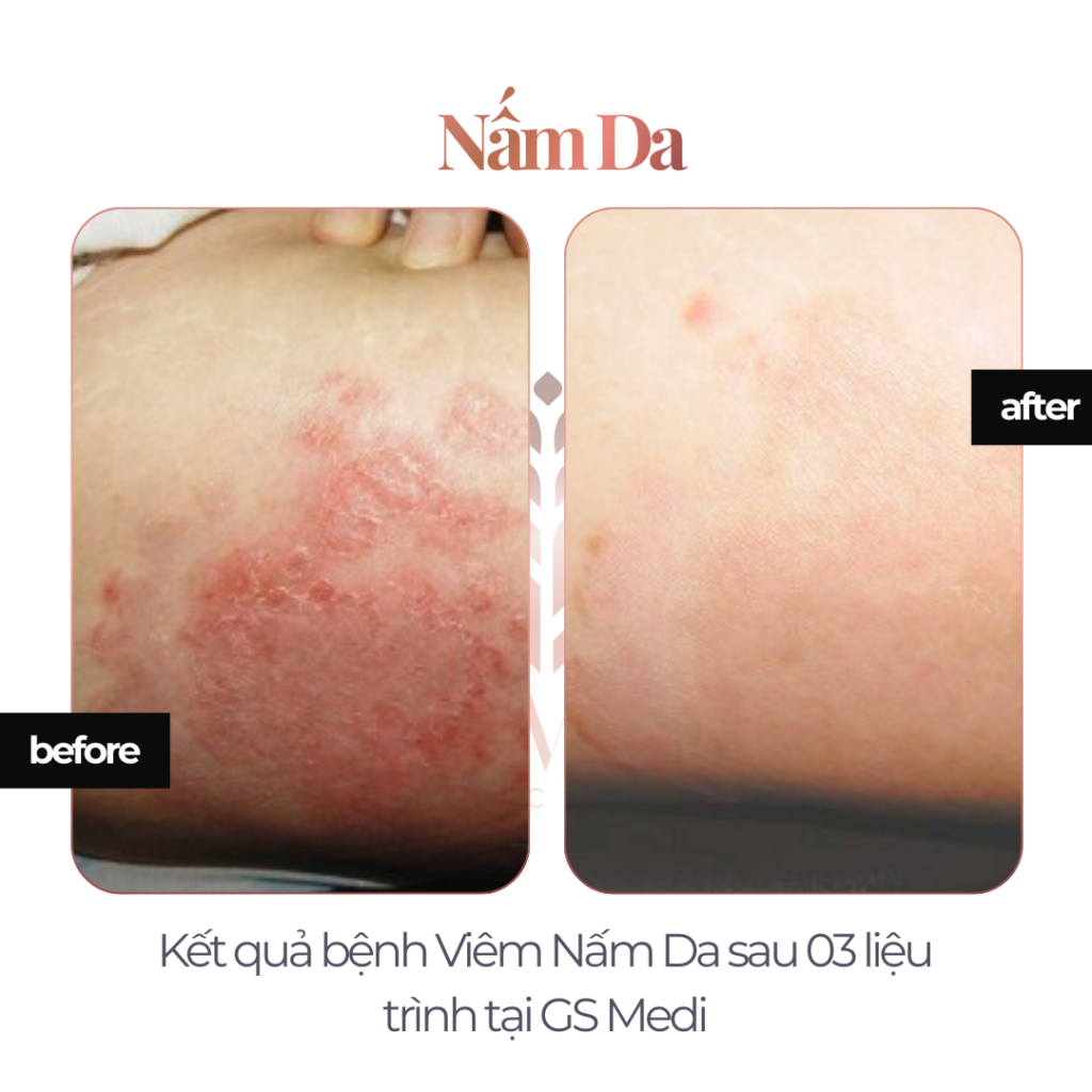 Điều trị Nấm Da tại GS Medi