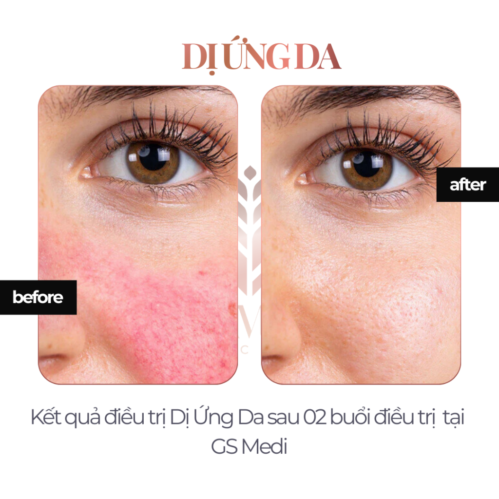 Điều trị Dị Ứng Da tại GS Medi