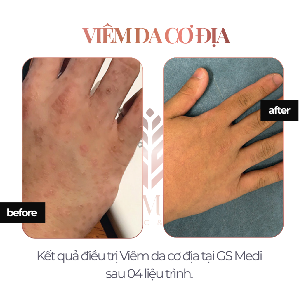Điều trị Viêm Da Cơ Địa tại GS Medi