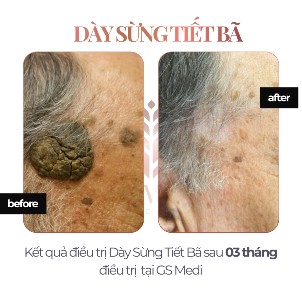 Kết quả điều trị Dày Sừng Tiết Bã sau 03 tháng điều trị tại GS Medi