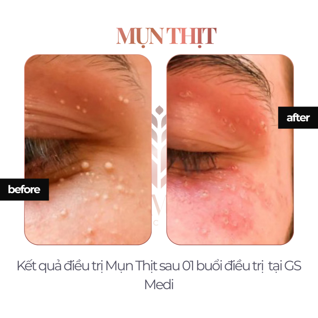 Kết quả điều trị Mụn Thịt sau 01 buổi điều trị tại GS Medi