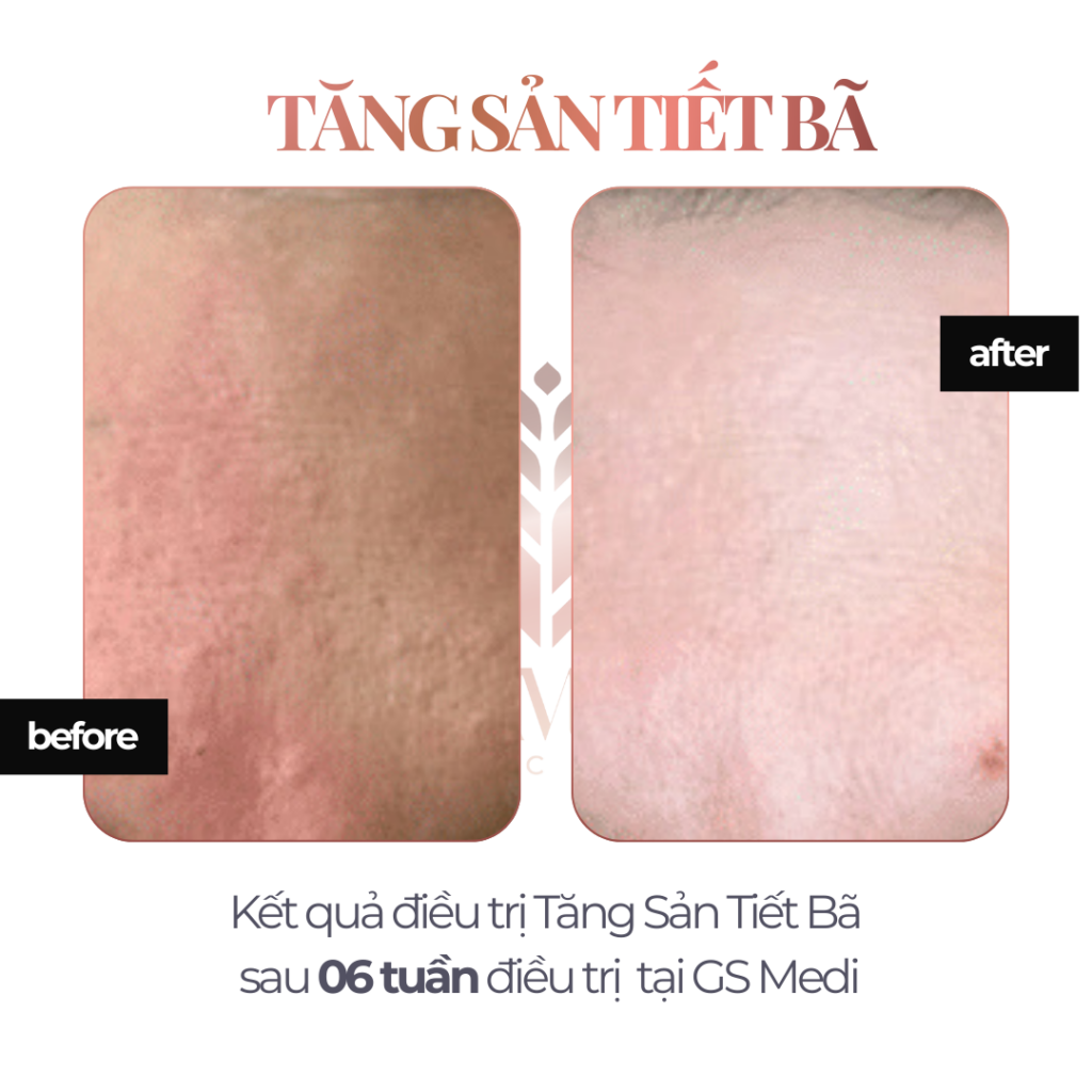 Kết quả điều trị Tăng Sản Tiết Bã sau 06 tuần điều trị tại GS Medi