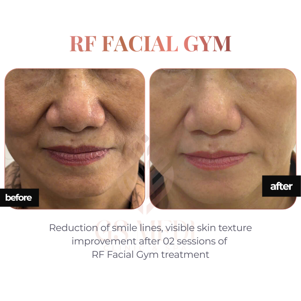 Result of RF tightening treatment