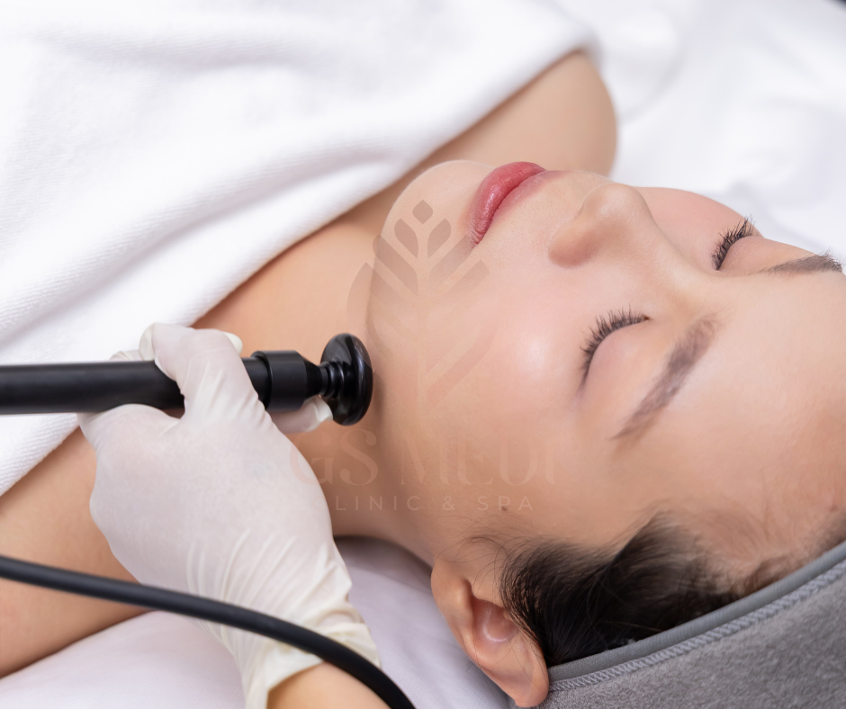 RF SKIN TIGHTENING AT GS MEDI CLINIC - SPA
