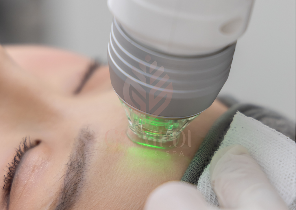 rf microneedling treatment