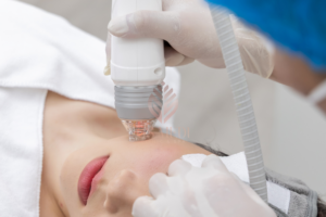 Điều trị sẹo rỗ sau mụn bằng công nghệ RF MicroNeedling tại GS MEDI Clinic & Spa-2