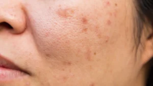 Da mặt bắt đầu mụn, lỗ chân lông to của một khách hàng tại GS Medi sau 2 tuần tháng 04 tại Sài Gòn