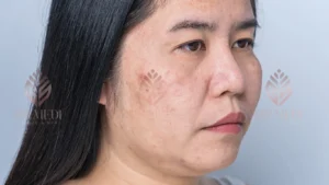Mảng nám bắt đầu hình thành trên mặt một khách hàng tại GS Medi Clinic