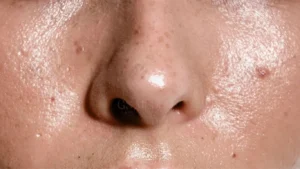 Nắng nóng khiến da tiết nhiều dầu hơn