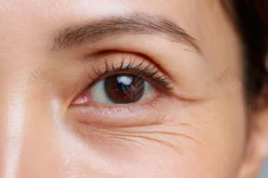 Nếp nhăn đuôi mắt và da chùng vùng mắt dưới – dấu hiệu da mất đàn hồi