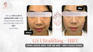 Kết quả trước và sau điều trị HIFU tại GS Medi – rãnh cười và quầng thâm mắt mờ rõ rệt sau 1 lần