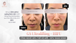 Before after nâng cơ HIFU Sonic SMAS tại GS Medi – da căng sáng, rãnh cười và quầng thâm cải thiện sau 01 liệu trình 
