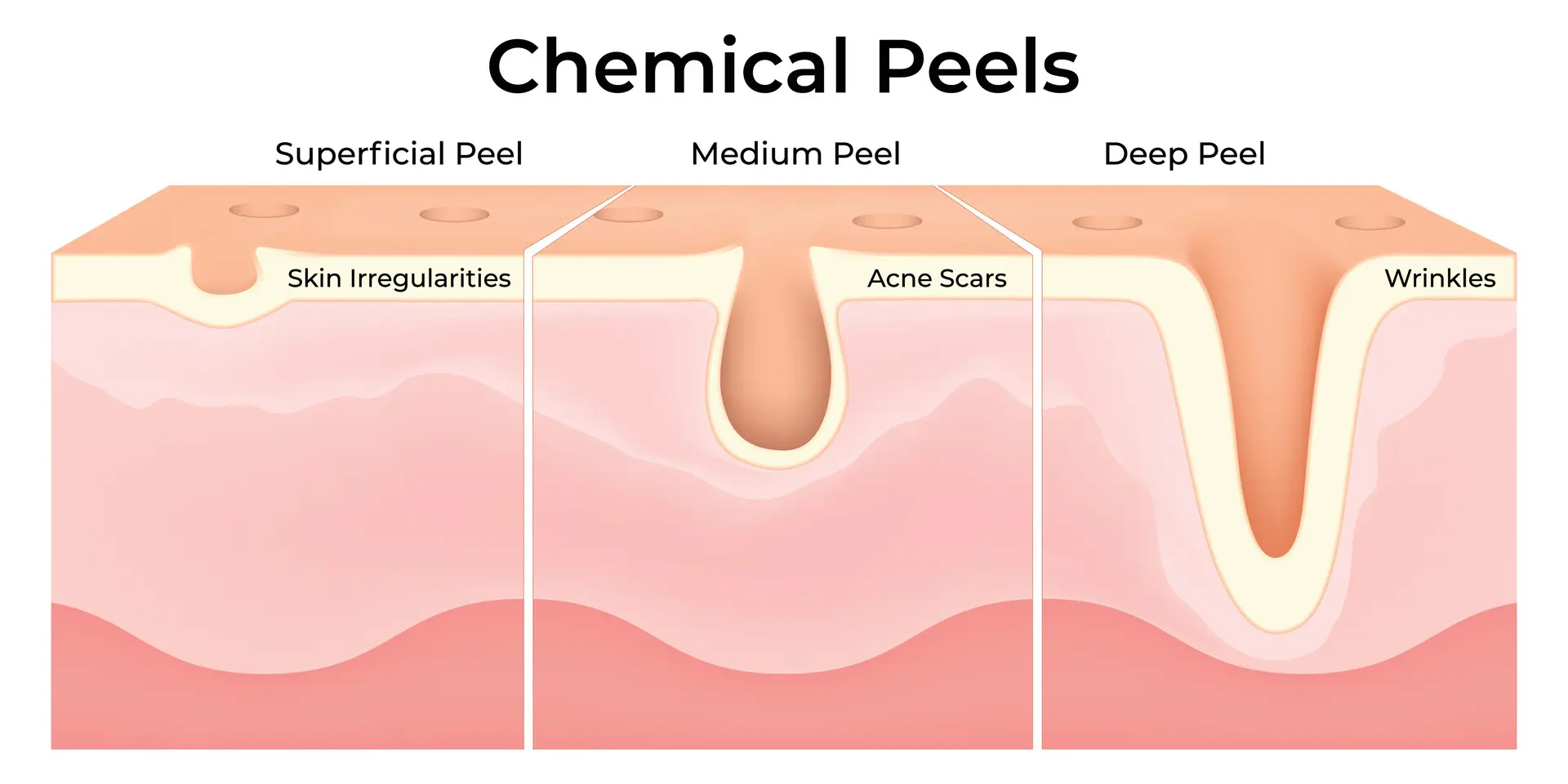 gsmedi chemical peels