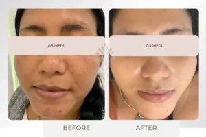 Kết quả điều trị sạm da, thâm nám toàn mặt bằng Laser O2 tại GS Medi – da sáng đều sau liệu trình