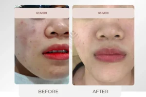 Trước và sau mờ thâm mụn, đều màu da vùng má và quanh miệng bằng Laser O2 tại GS Medi