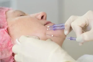 khach hang nu duoc bac si thuc hien lieu trinh chi collagen